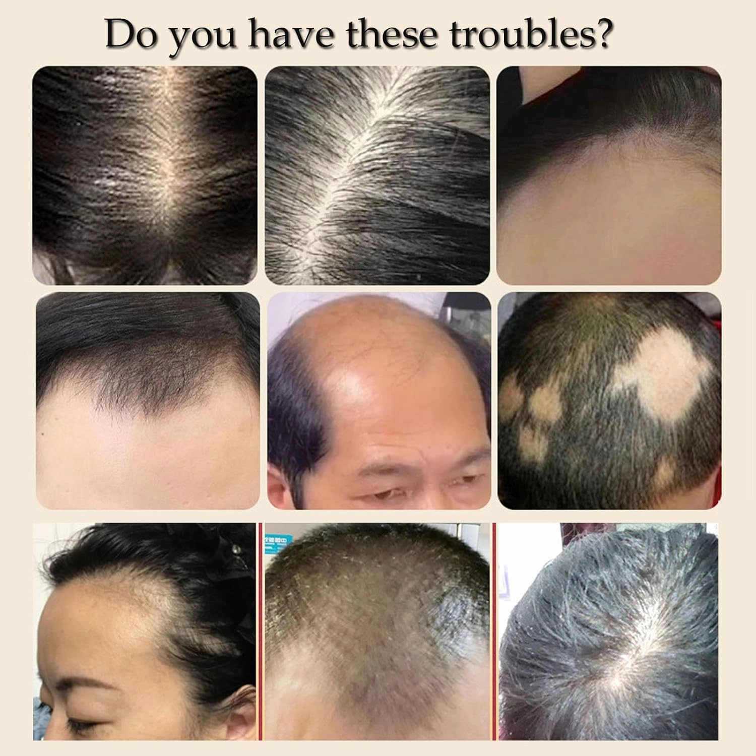 Anti-Hair Loss And Hair Growth Solution,35ml Hair Solution,Ginger Hair Growth Serum,Hair Solutions For Thinning Hair,Plant Ginger Hair Essence Hair Growth Serum For Men Women (4PCS)